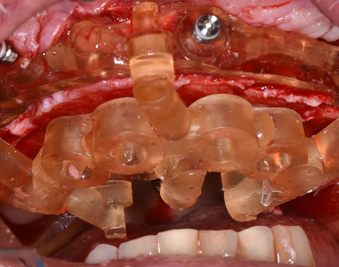 Guía de implantes montada sobre la guía base en el maxilar superior, durante la cirugía; abajo se ven los dientes inferiores